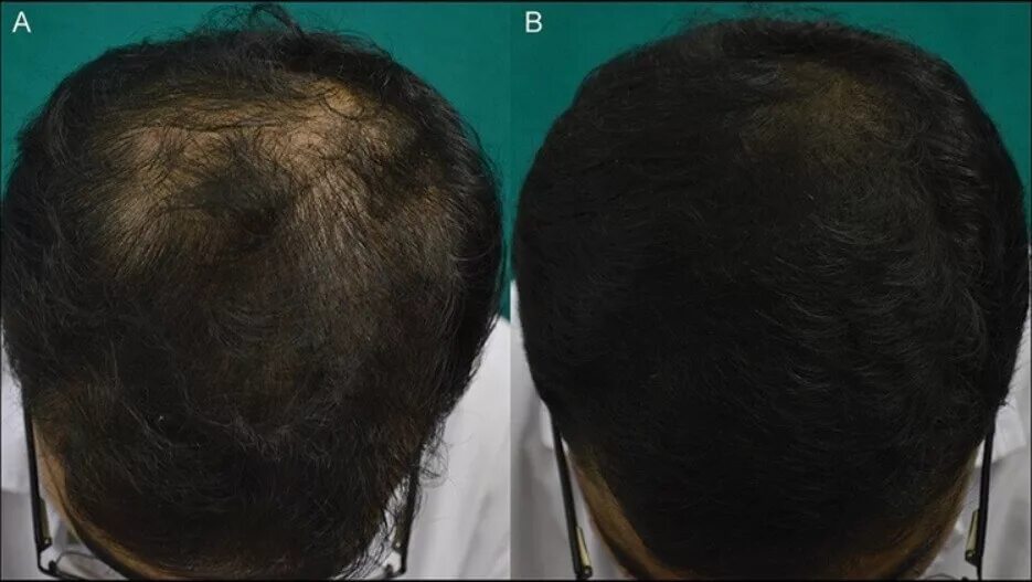 Повреждение волос. Ботокс степени повреждения волос. Пятая степень повреждения волос.