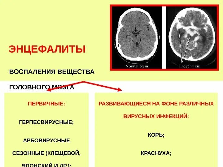 Энцефалит головного мозга. Воспаление головного мозга. Энцефалит серого вещества. Энцефалитное воспаление головного мозга. Воспаление головного мозга латынь