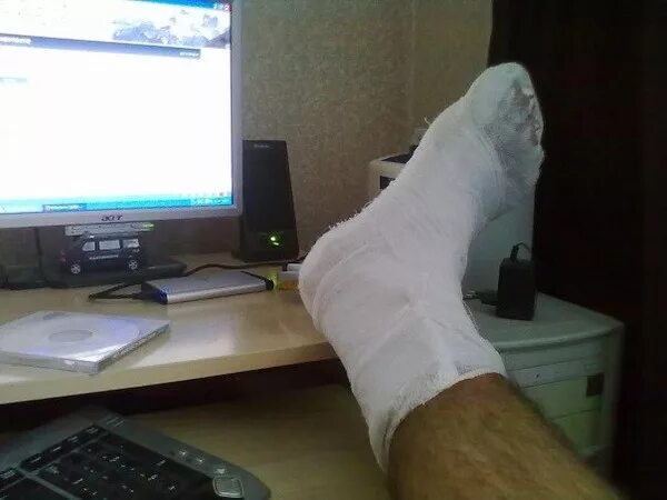 Гипсовая лонгета на голеностопный сустав. Гипс болтается на ноге. Гипс болтается на ноге. Гипс болтается на ноге. Гипс болтается на ноге.