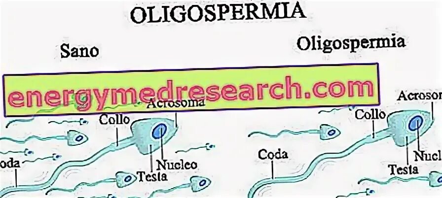 Причины олигоспермии. Олигоспермия причины. Спермограмма олигоспермия. Олигозооспермия что это такое у мужчин. Олигоспермия это.