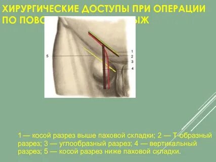 Грыжа бедра