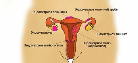 Эндометриоз после месячных
