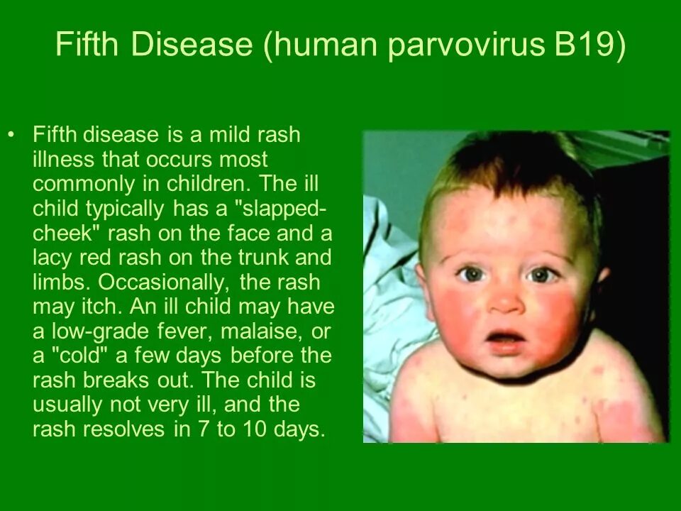 Парвовирус у детей лечение. Парвовирус b19 инфекционная эритема.
