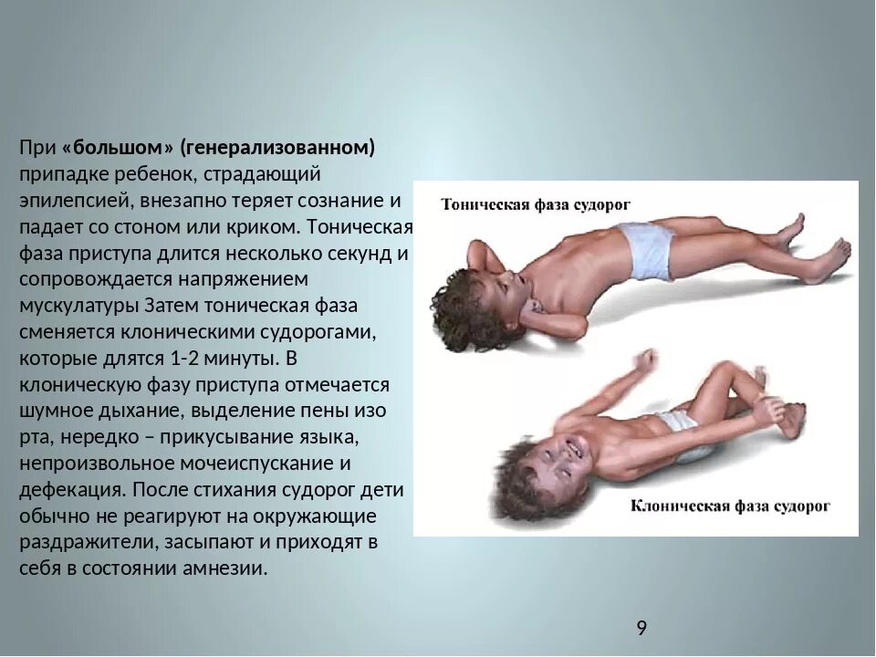 Эпилептический приступ. Эпилептические судороги. Генерализованные припадки эпилепсии.