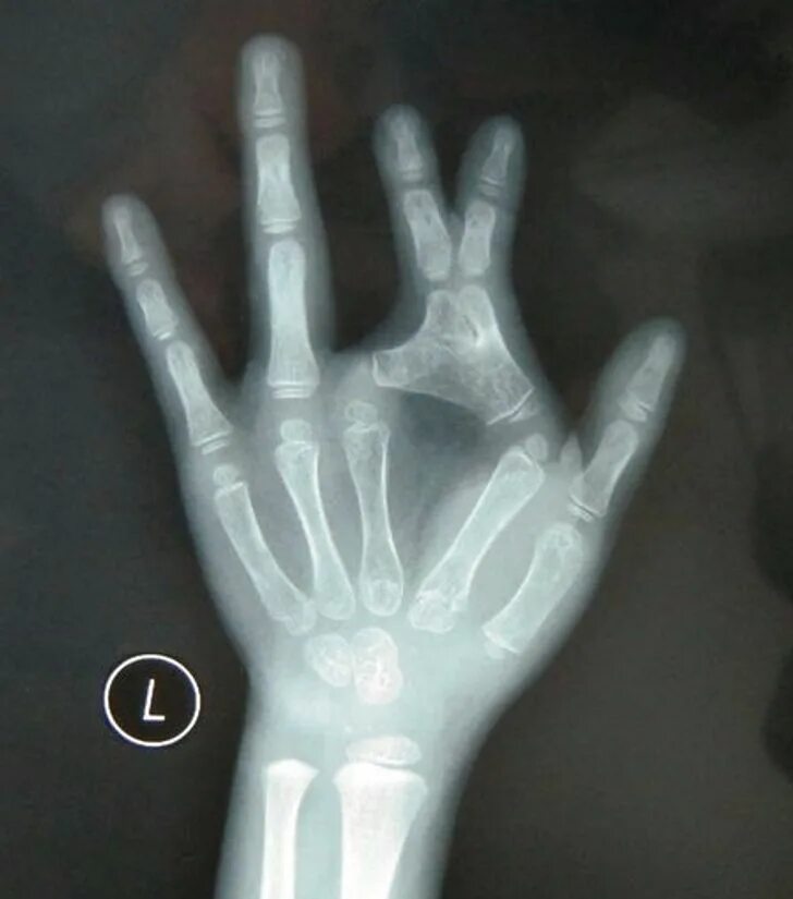 Сросшиеся фаланги пальцев. Сросшиеся фаланги пальцев. Синдактилию патология. Клинодактилия мизинцев. Сросшиеся фаланги пальцев.