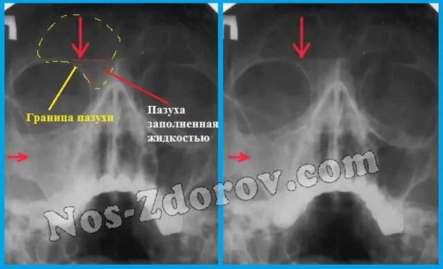 Уровень на рентгене. Левосторонний фронтит на рентгене. правосторонний фронтит на рентгене. фронтит рентген на снимке. фронтит рентген лобной.