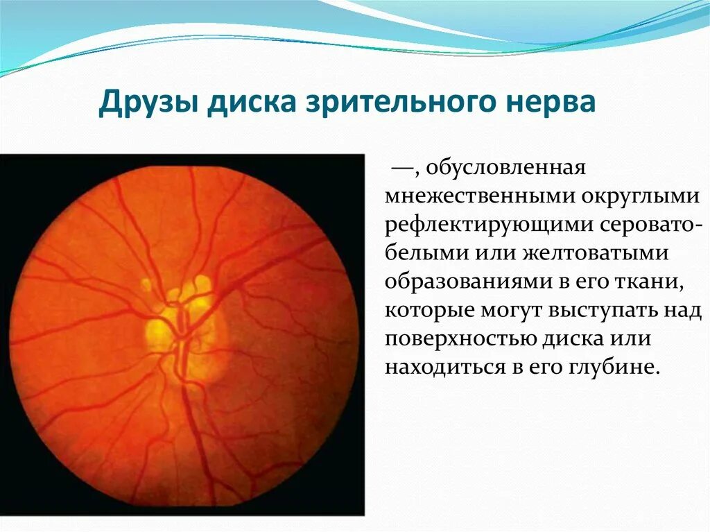 Место выхода зрительного нерва не воспринимающее лучей. ДОУЗД зрительного нерва. Друзы диска зрительного нерва. Друзы зрительногон нерва. Аномалии экскавации зрительного нерва.