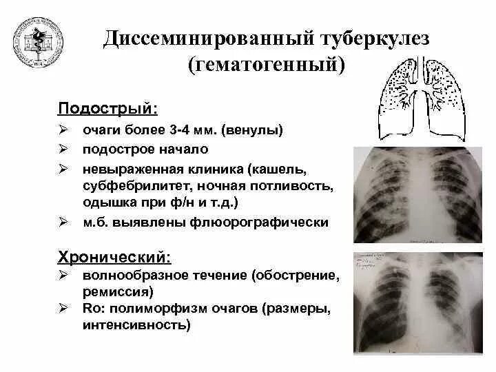 Диссеминированный туберкулез легких фазы. Диссеминированный туберкулез острый подострый и хронический. Подострый диссеминированный туберкулез рентген. Хронический диссеминированный туберкулез рентген. Подострый диссеминированный туберкулез клиника.