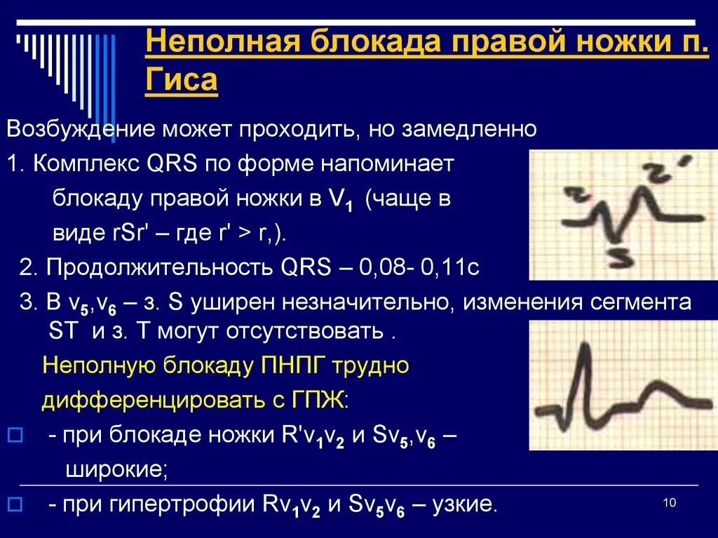 Нарушение блокады гиса. Неполная блокада правой ножки пучка Гиса на ЭКГ. Признаки неполной блокады правой ножки пучка Гиса на ЭКГ. Неполная блокада ножек пучка Гиса на ЭКГ. Блокада правой ножки пучка Гиса на ЭКГ.