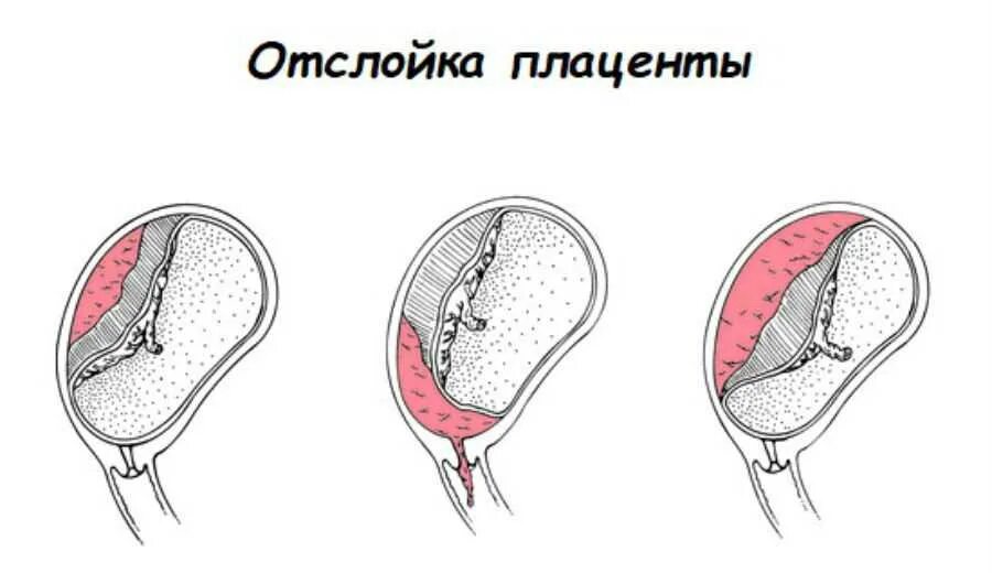Почему отслойка на свободном крае. Преждевременная отслойка плаценты. отслойка нормально расположенной плаценты классификация. отслойка плаценты и гематома. краевая отслойка плаценты причины.