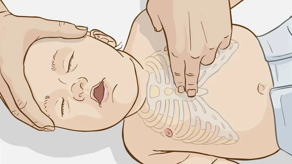 Закрытый массаж сердца детям. У новорождённых непрямой массаж сердца проводится. непрямой массаж сердца у детей. непрямой массаж сердца детям до года.