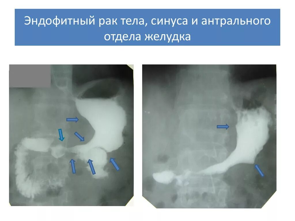 Экзофитная опухоль желудка рентген. Опухоль антрального отдела желудка рентген. Раковая опухоль желудка рентген. Экзофитный са тела желудка. Диффузный антральный