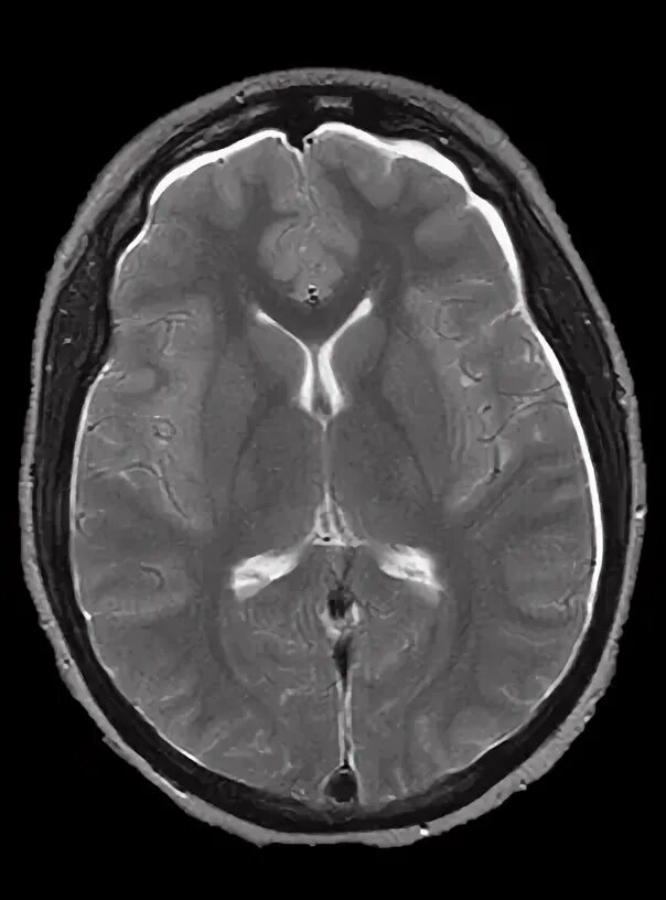 Внутричерепное давление головного мозга. Мрт при внутричерепной гипертензии. Мрт головного мозга внутричерепное давление. Внутричерепное давление на мрт головы.