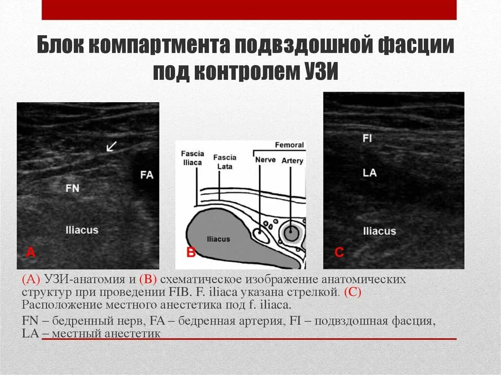 Блокада под узи. Это блокада нерва под УЗИ контролем. Анатомия под УЗИ контролем. Подошвенная фасция на УЗИ.