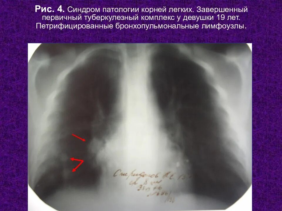 Первичный туберкулезный комплекс рентген синдром. Синдром инфильтрации корня легкого. Патология корня легкого рентген.