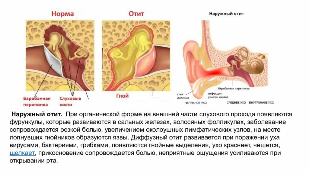 Заболевания среднего уха. Заболевания среднего уха фото.