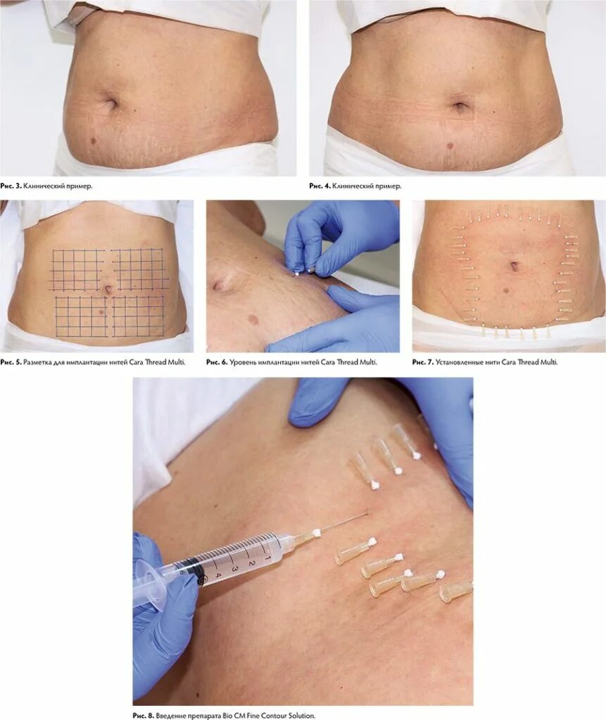 Нитевой лифтинг на живот после кс. Мезонити армирование живота. Нитевой лифтинг на живот после кс. Подтяжка живота нитями до и после. Нити в живот для подтяжки.