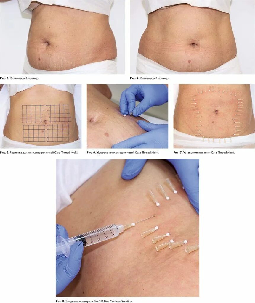 Подтяжка груди цены отзывы. Мезонити армирование живота. Подтяжка кожи живота нитями Аптос. Нитевой лифтинг на живот после КС. Подтяжка дряблого живота нитями.