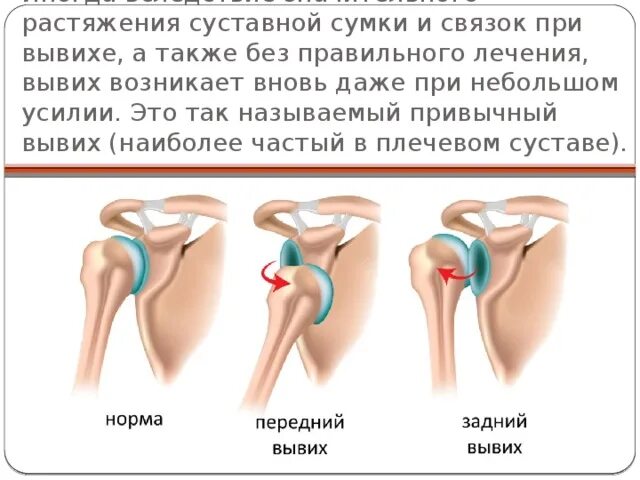 Травма плечевого сустава разрыв связок. Суставная сумка плечевого сустава травма симптомы. Разрыв суставной сумки плечевого сустава. Перерастяжения суставной сумки. Разрыв плечевого сустава симптомы