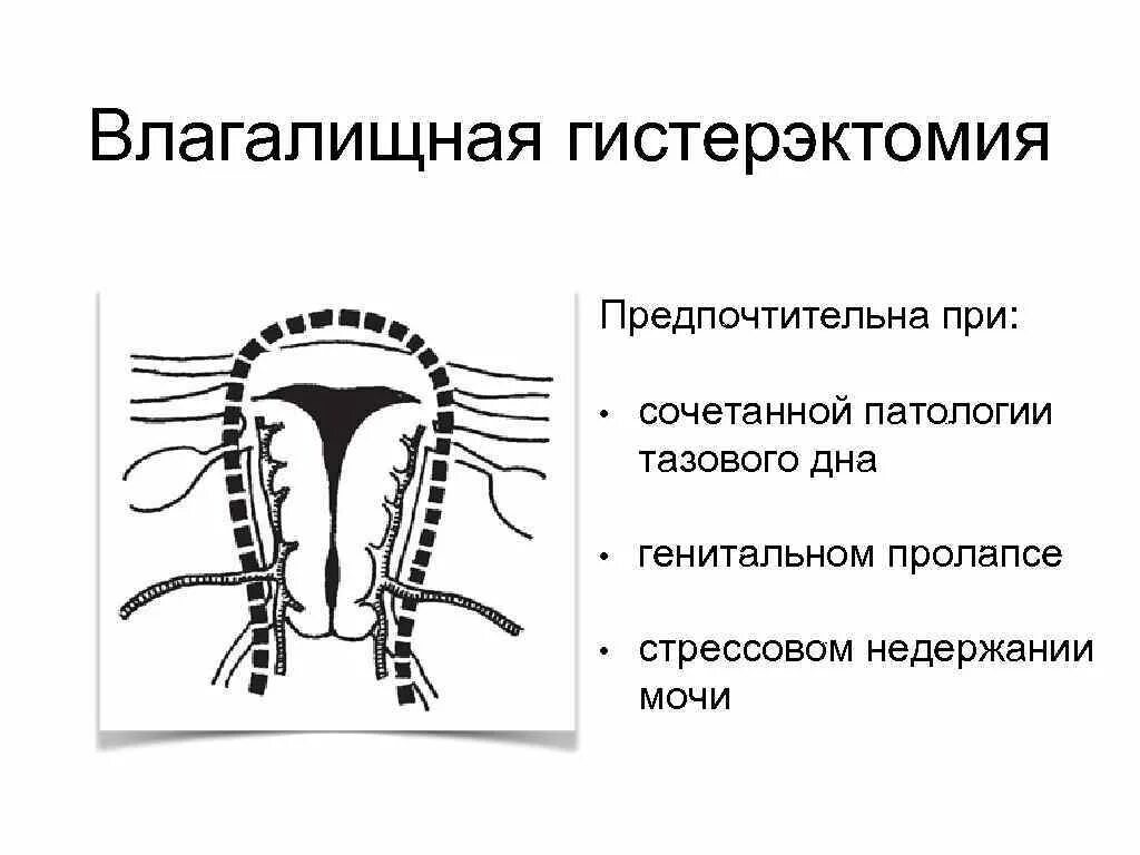 Гистерэктомия что это такое простыми. Влагалищная гистерэктомия. Этапы влагалищной экстирпации матки. Влагалищная экстирпация матки с придатками. Влагалищная экстирпация матки ход операции.