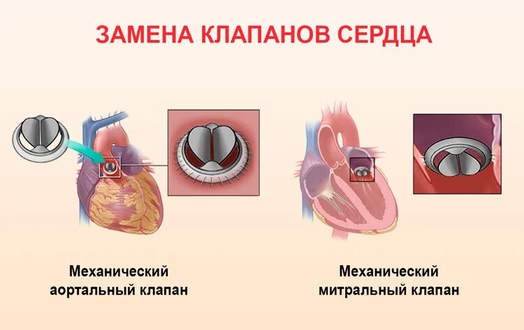 Замена клапана инвалидность