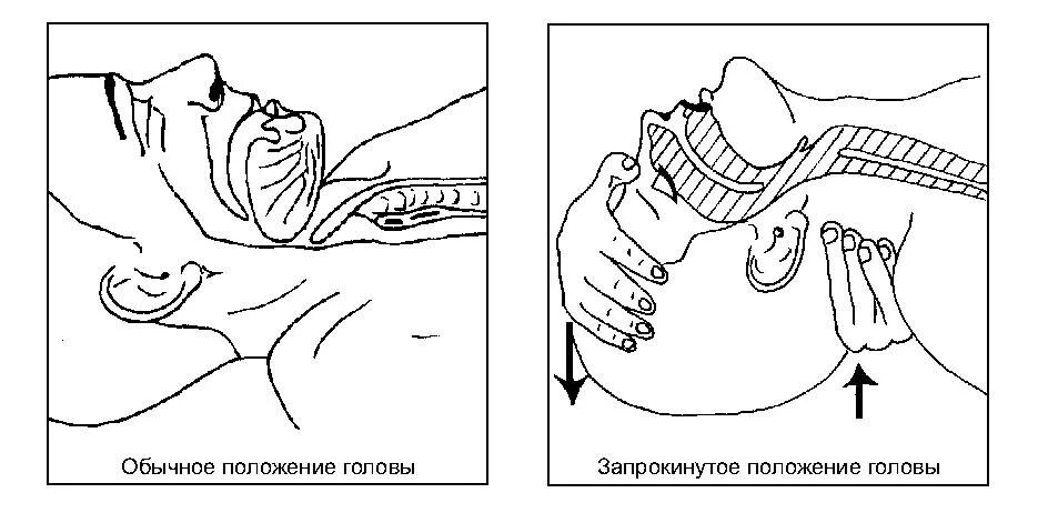 Метод поддержания дыхательных путей. Обеспечение проводимости верхних дыхательных путей.. восстановление проходимости дыхательных путей при слр. обеспечить проходимость дыхательных путей. обеспечение проходимости дыхательных путей при слр.
