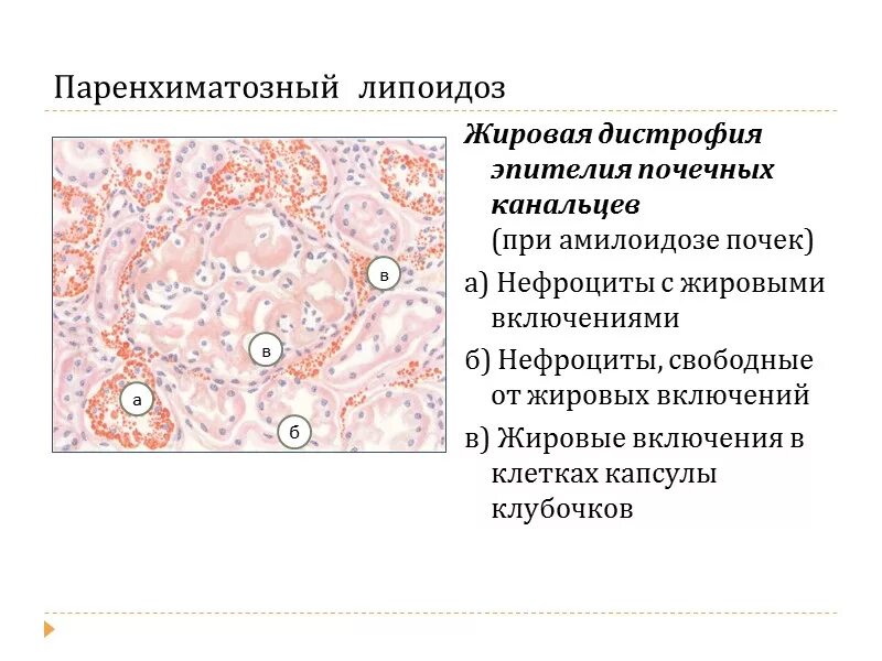 Белковые канальцы. Некротический нефроз гистология. Жировая дистрофия почек микропрепарат. Гидропическая дистрофия почки макропрепарат. Жировая дистрофия эпителия почечных канальцев.