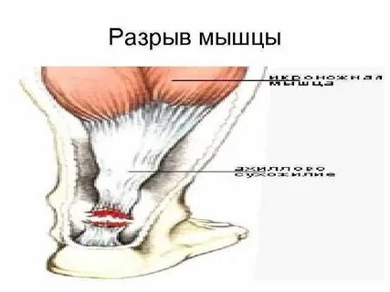 Повреждение мышц
