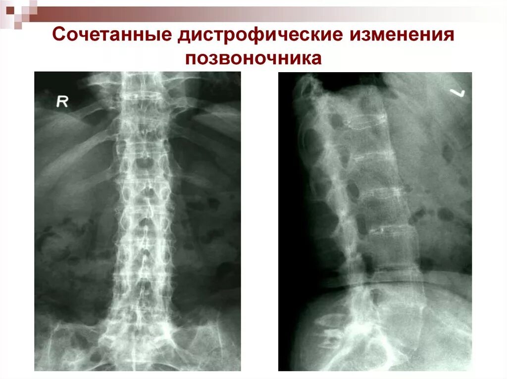 Мр дистрофических изменений пояснично крестцового отдела позвоночника. 6 Поясничных позвонков рентген. Рентген поясничного отдела позвонка. Дистрофические изменения поясничного отдела позвоночника. Дегенеративные изменения пояснично-крестцового.