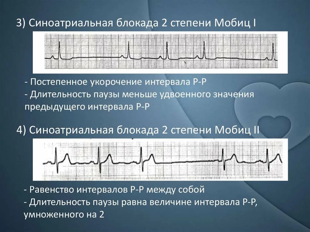 Комплекс блокада. Синоатриальная блокада 2 степени 3:2. Синоатриальная блокада 3 степени на ЭКГ. Синоатриальная блокада 2 степени 1 типа. Са блокада 2 степени 2 типа на ЭКГ.