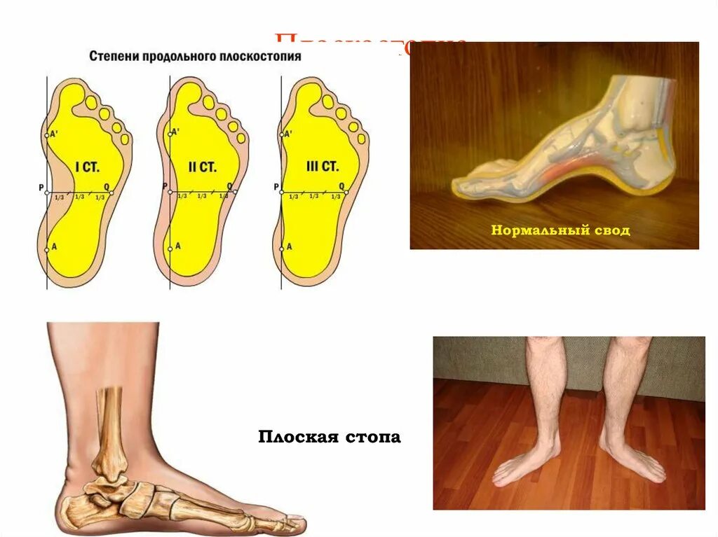 Средняя стопа. Продольное плоскостопие 2б. Продольный свод стопы плоскостопие. Плоскостопие 3 степени вид сбоку. Плоскостопие поперечного свода стопы.