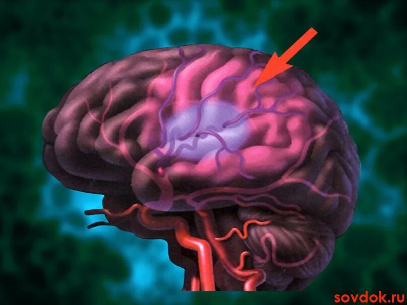 Нарушение кровообращения цнс. Ишемия мозгового инсульта. Ишемия коры головного мозга. Ишемия сосудов головного мозга. Гипоксия сосудов головного мозга.