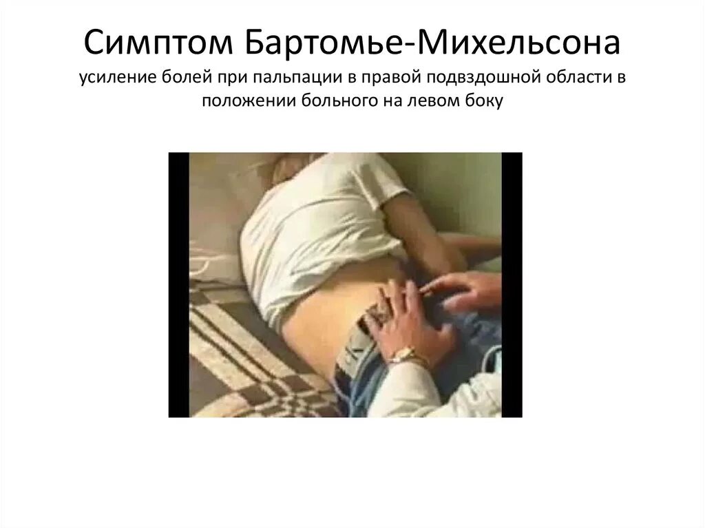 Бартомье-михельсона техника выполнения. Симптом бартомье при аппендиците. Симптом бартомье при аппендиците. Симптом воскресенского рубашки. Острый аппендицит симптом бартомье.