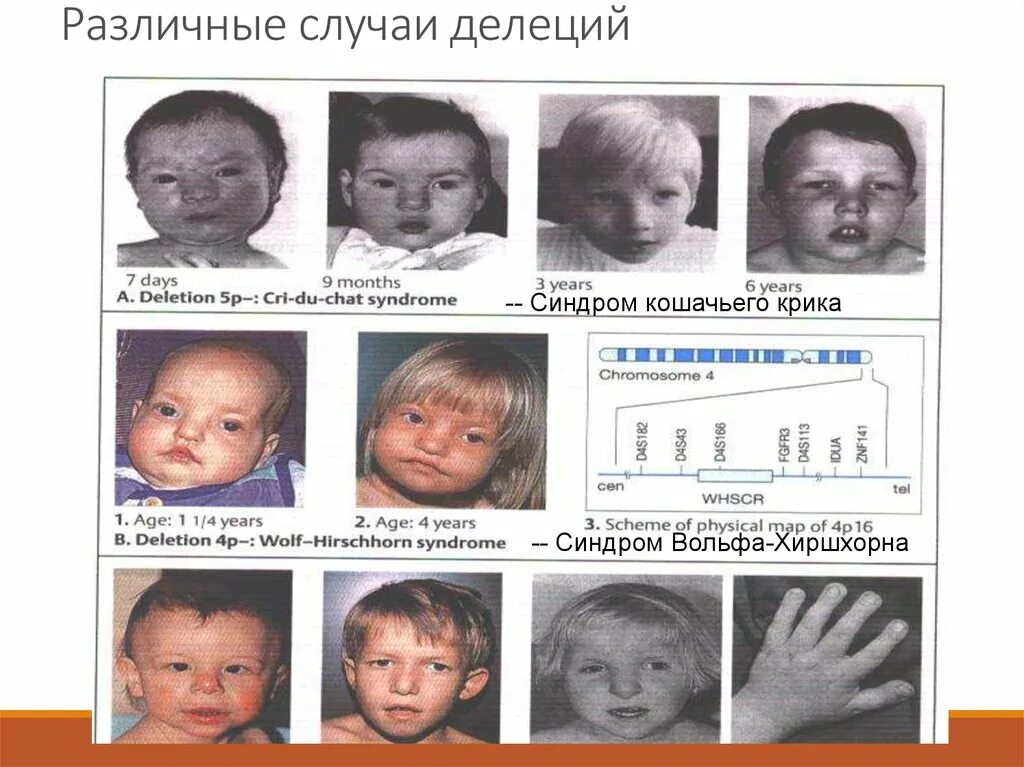 Синдром вольфа кариотип. Синдром вольфа-хиршхорна. делеция короткого плеча 4 хромосомы.