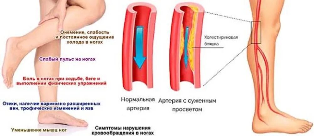 Слабость после ходьбы