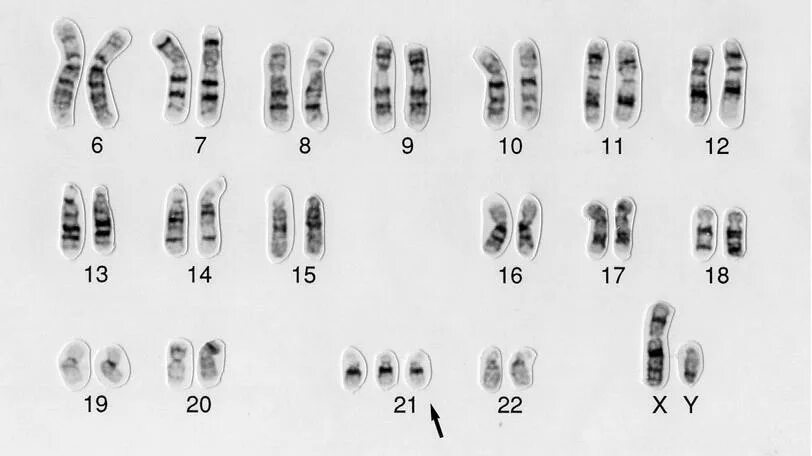 Синдром Дауна 21 хромосома. Синдром Дауна трисомия 21 хромосомы. Кариограмма синдрома Дауна. Лишняя 21 хромосома