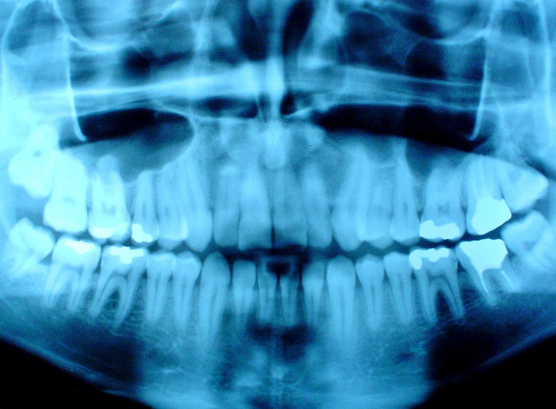 Рентгеновский снимок в стоматологии. Рентгенологическое исследование зубов.
