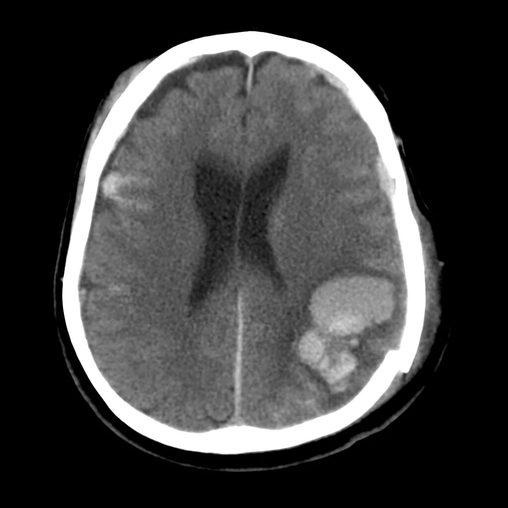 Травма мозга очаговая. Контузионный очаг мозга кт.