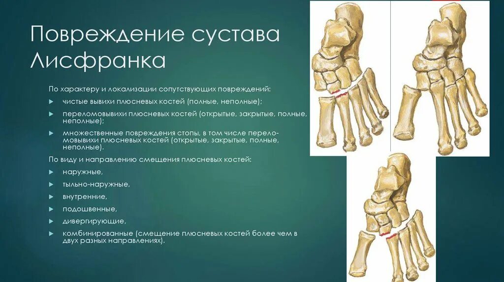 Пятка состав. Шапаров сустав и Лисфранка. Поперечный сустав предплюсны шопаров сустав. Шопаров и лисфранков суставы. Шопаров сустав и сустав Лисфранка.