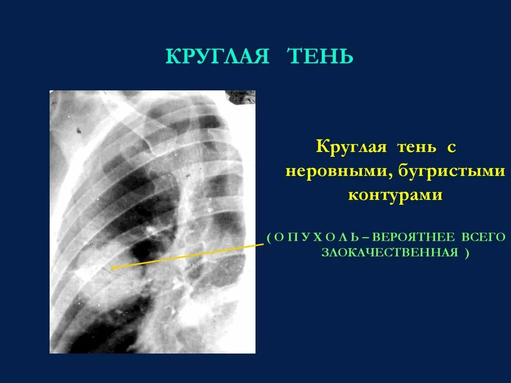 Верхние доли легких тени. Очаговая тень. Округлая тень в легком. Округлые тени в легких.