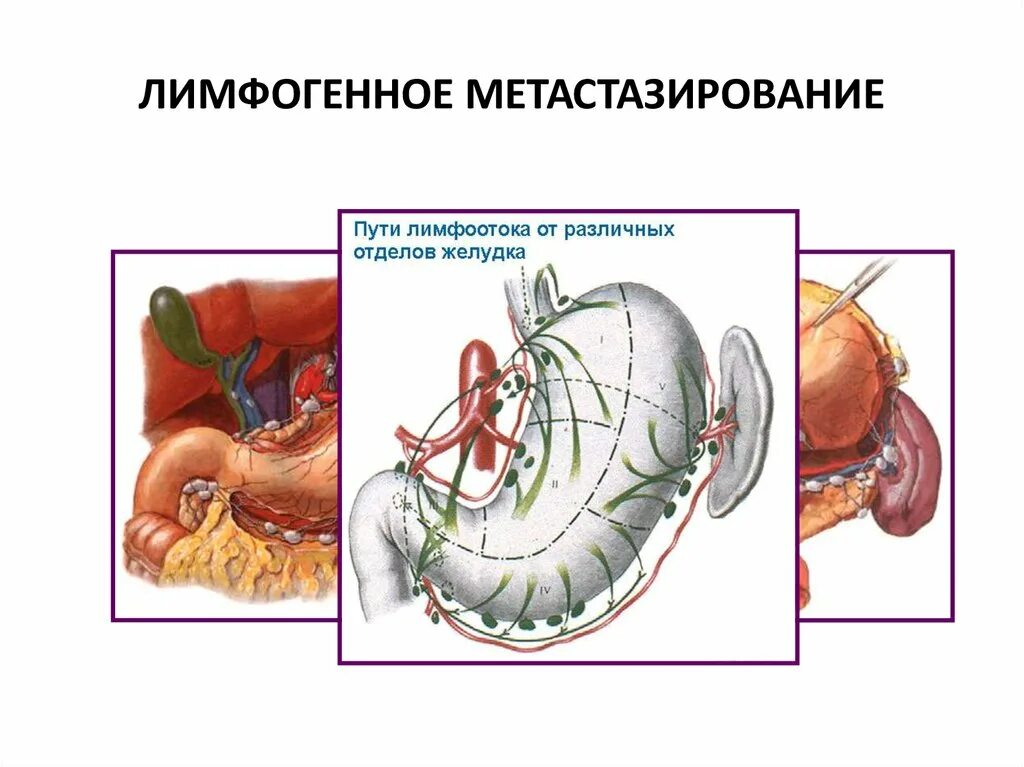 Пути метастазирования рака. Лимфогенное метастазирование. Лимфогенный путь. Лимфогенный путь распространения метастаз. Лимфогенное метастазирование опухоли.