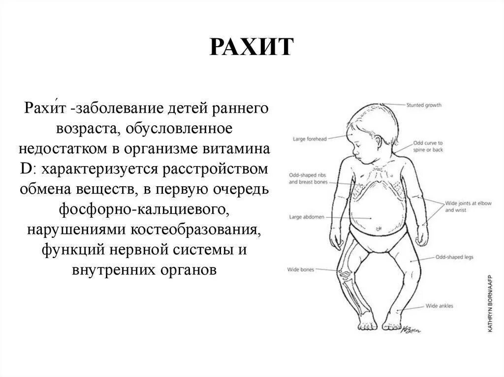 1 признаки рахита. Рахит у детей симптомы у младенцев 4 месяца. Рахит 2 степени до года. Нехватка витамина д симптомы рахит.