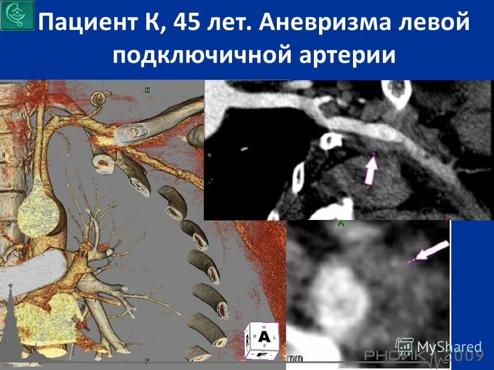 Мскт аортография. Мскт аортография