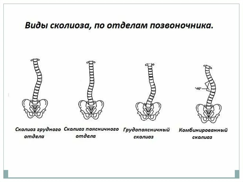 Деформация позвоночных