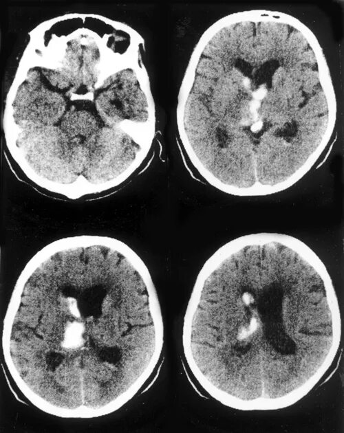 Кровоизлияние в желудочки. Геморрагический инсульт кт. Геморрагический инсульт на кт ангиографии. Геморрагический инсульт кт картина. Геморрагический инсульт головного мозга кт.