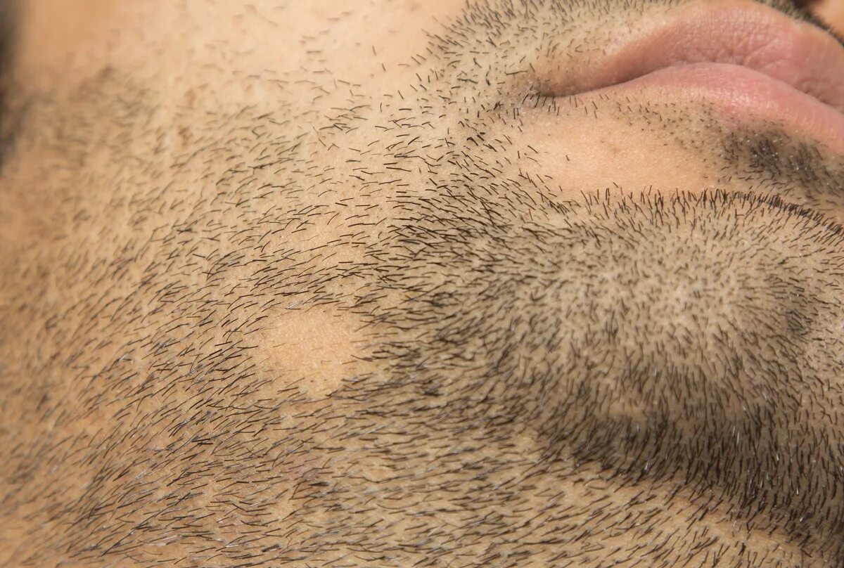 Очаговая алопеция бороды. Появление волосяного покрова