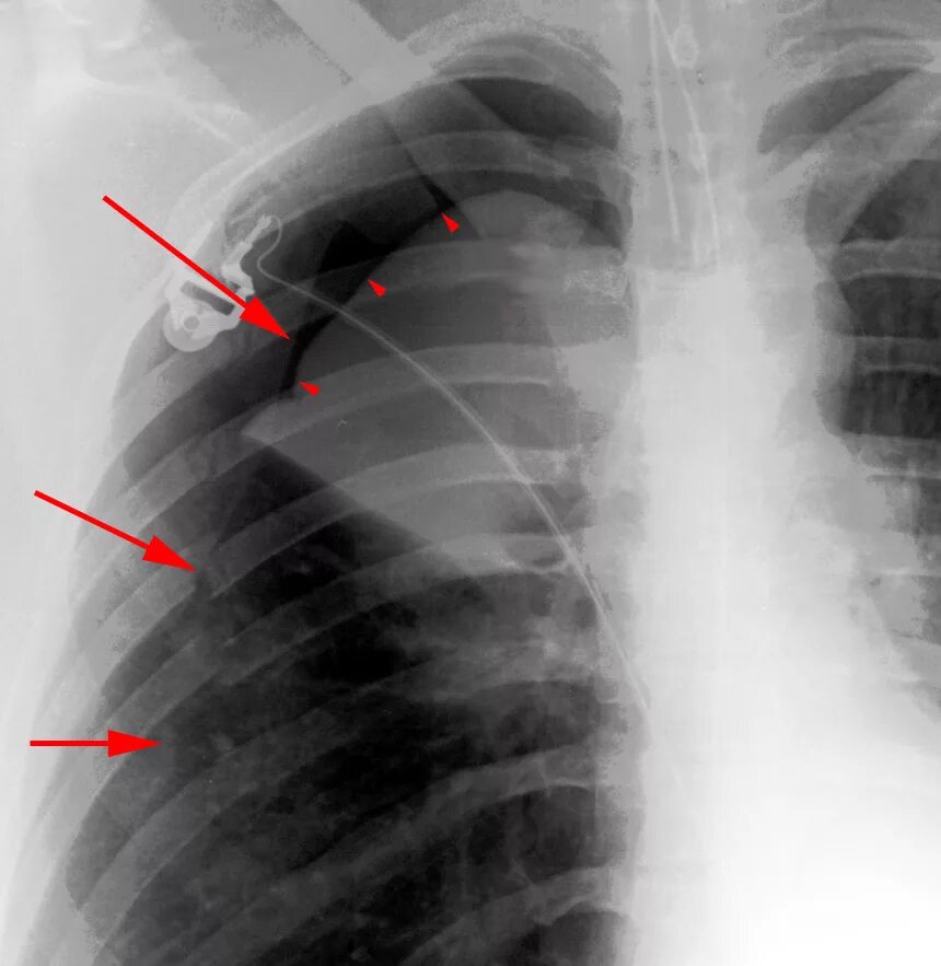 Пневмоторакс рентген. Плащевидный пневмоторакс на рентгене. Спонтанный пневмоторакс рентген. Пневмоторакс лёгких рентген. Тень в левом легком