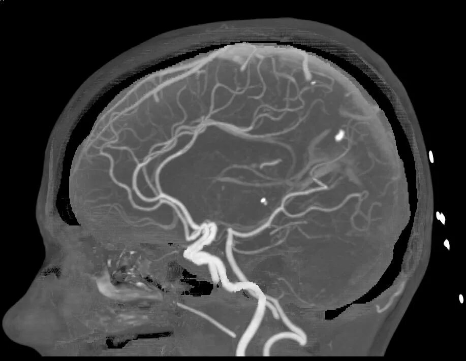 Магнитно-резонансная ангиография головного мозга. МР-ангиография сосудов головного мозга. Кт ангиография сосудов головного мозга. Кт ангиография аневризма.