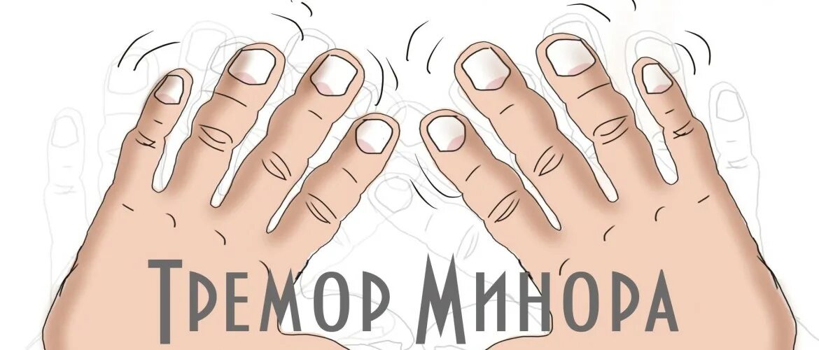 Тремор минора. Болезнь минора. Болезнь минора неврология. Эссенциальный тремор минора.