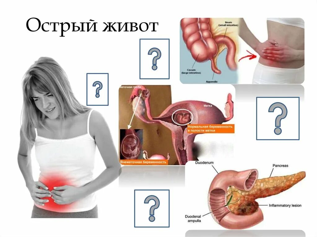 Тема острый живот. Острый живот. Острый Животв в гинекология. Понятие острый живот в хирургии. Понятие острый живот в гинекологии.